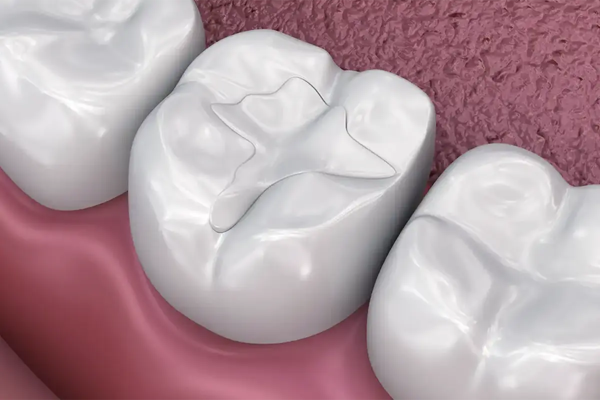 Fillings and Sealants