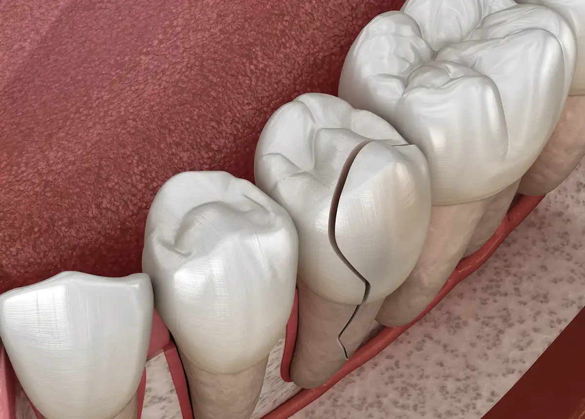 Broken, Cracked, or Chipped Tooth