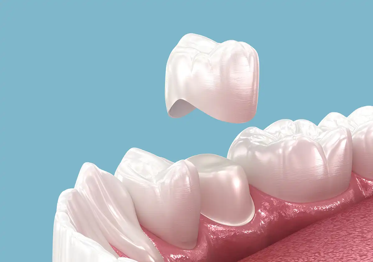 Filling, Crown, or Veneer Fell Out